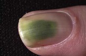 Bactreriële nagel infecties